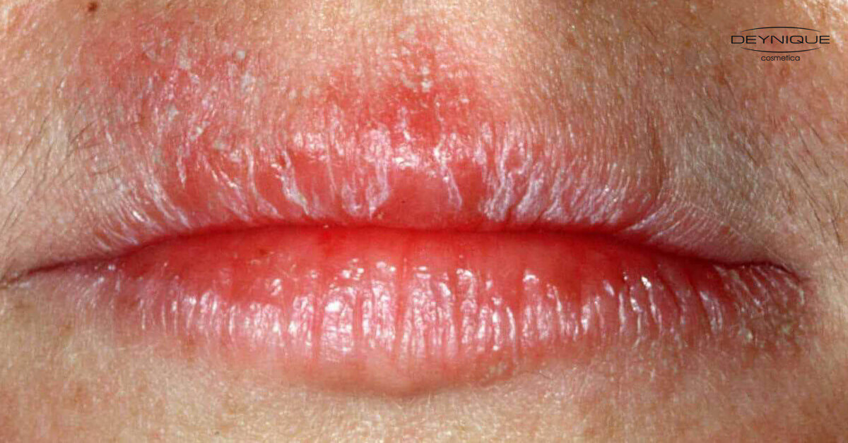 Gewoon schrale lippen of toch last van lippeneczeem? Gewoon schrale lippen of toch last van lippeneczeem?