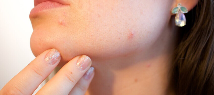 littekens acne